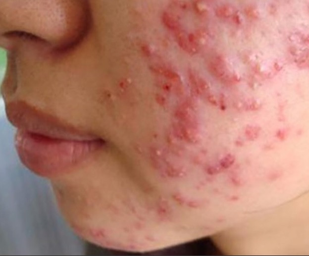 Phản ứng viêm ở da