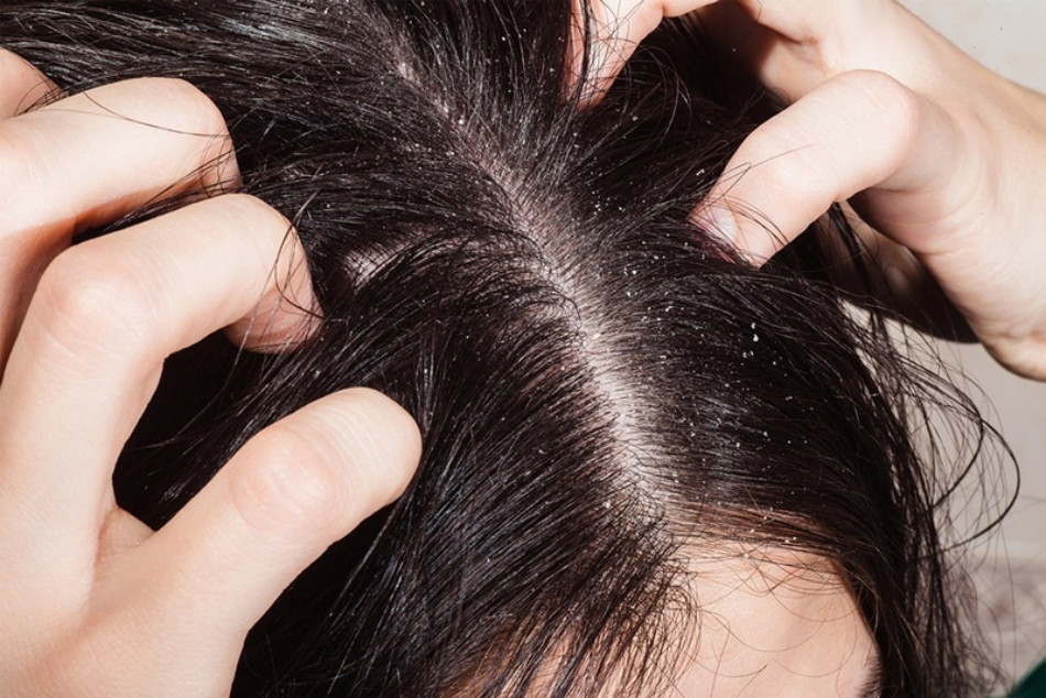 Phản ứng với sản phẩm chăm sóc tóc gây gàu