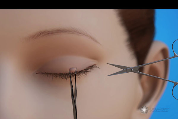 Phẫu thuật cắt bỏ mụn thịt