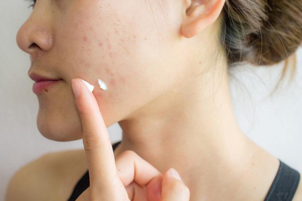 Phòng ngừa dị ứng kem chống nắng