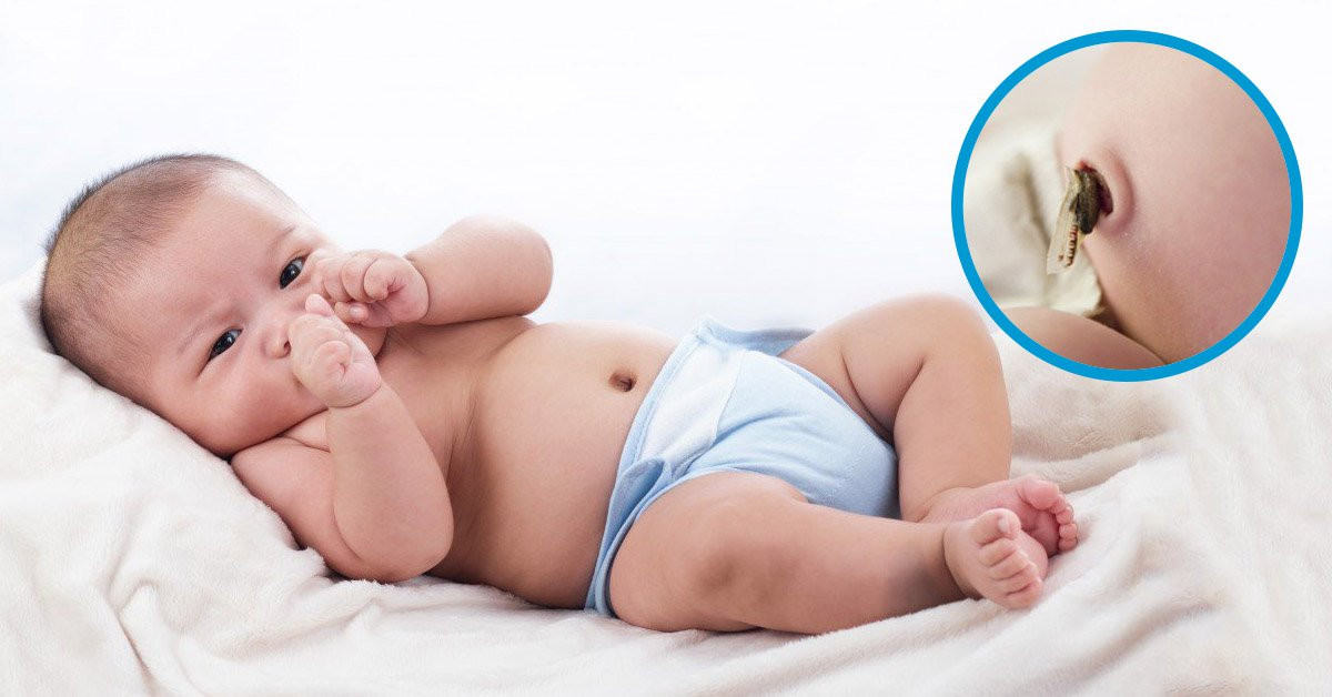 Nhiễm trùng rốn ở trẻ sơ sinh: các dấu hiệu (phần 1)