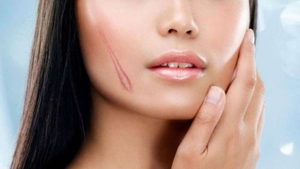 Rau má giúp ngăn ngừa sự hình thành sẹo