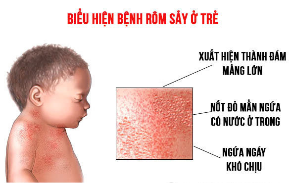 Các bệnh thường gặp của bé yêu vào mùa hè (phần 1)