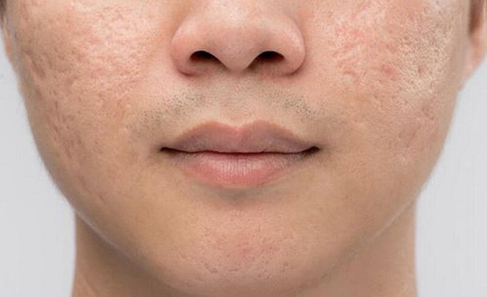 Cách xử lý và ngăn ngừa sẹo do mụn hiệu quả