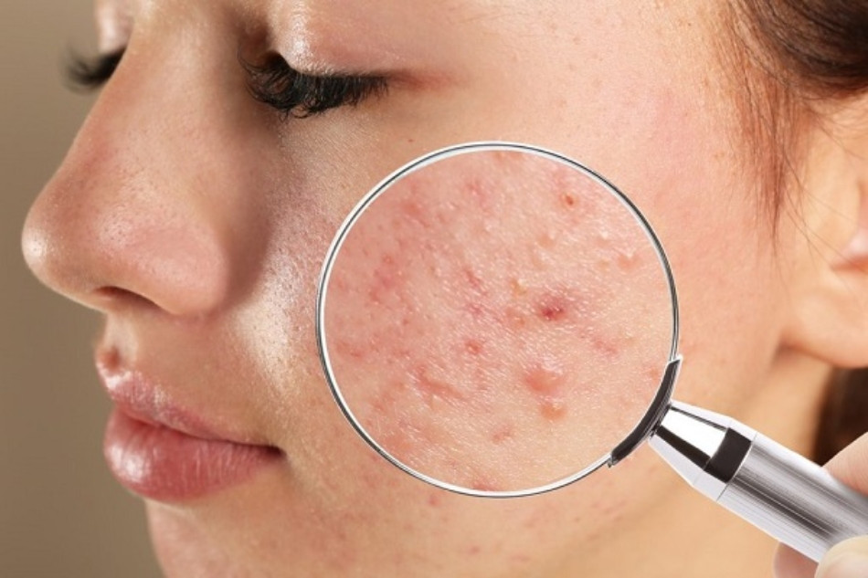 Skincare cho da dầu mụn ẩn