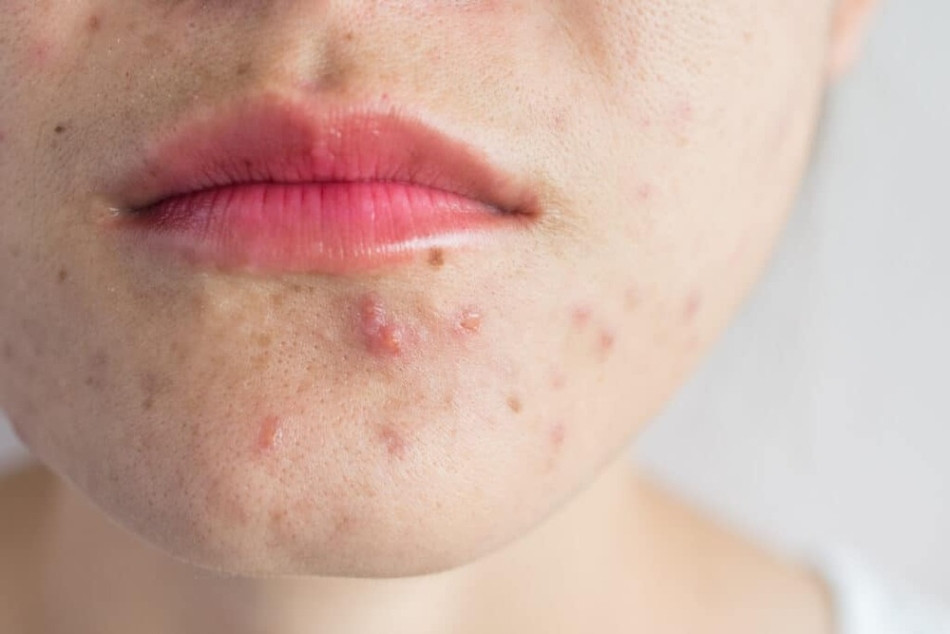 Skincare cho da dầu mụn viêm