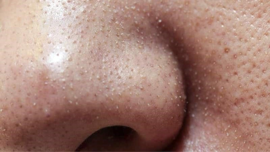 13 Cách Làm Sạch Sỏi Bã Nhờn Ở Mũi Hiệu Quả