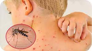 Các bệnh thường gặp của bé yêu vào mùa hè (phần 2)