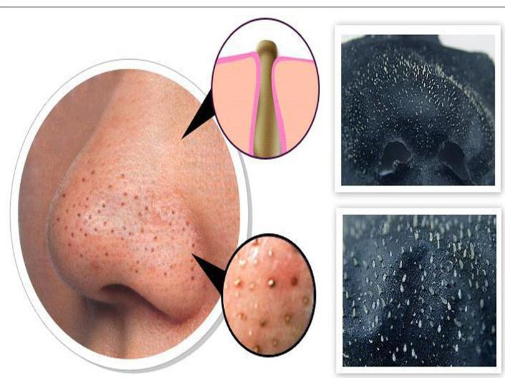 Sử dụng gel lột mụn để loại bỏ bã nhờn gây mụn đầu đen