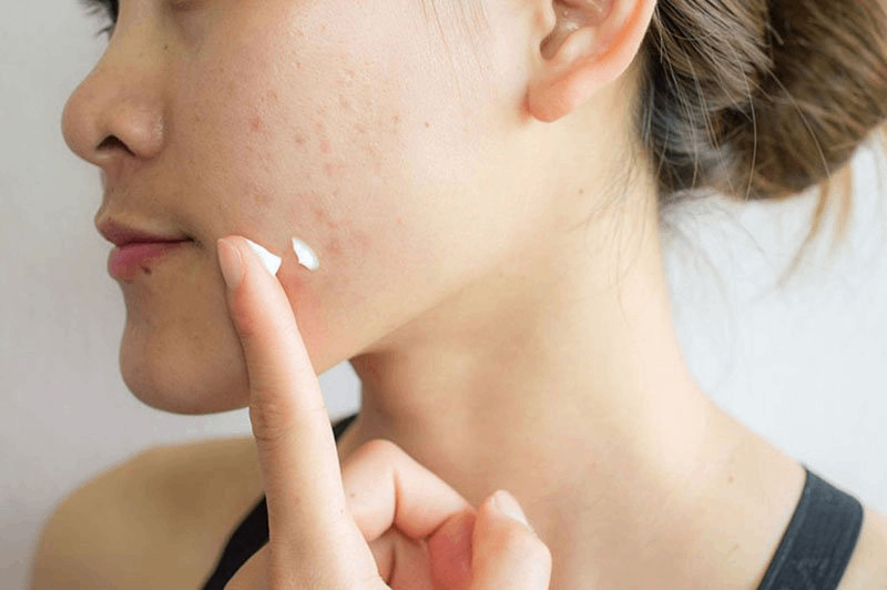 Sử dụng kem dưỡng ẩm để loại bỏ tình trạng nhân mụn tốt hơn
