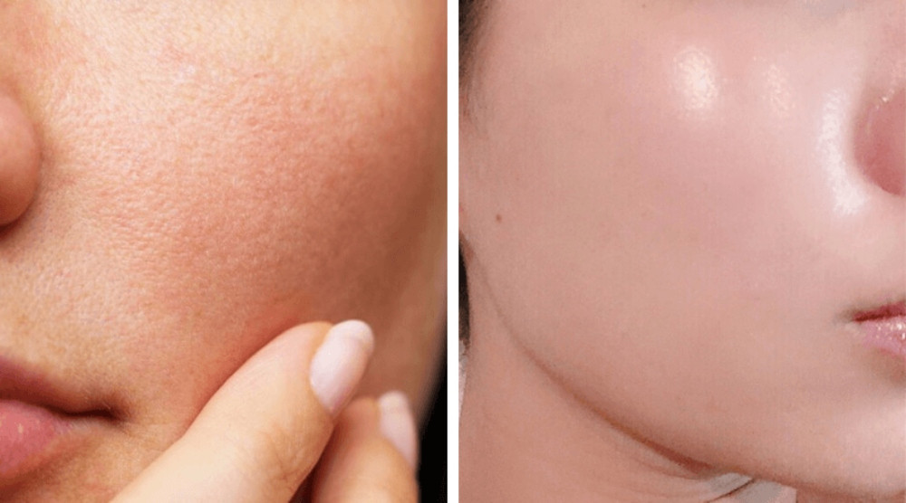 Sử dụng kem dưỡng để giúp se khít lỗ chân lông