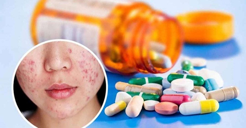 Sử dụng kem trị mụn hoặc thuốc kê đơn theo chỉ định bác sĩ