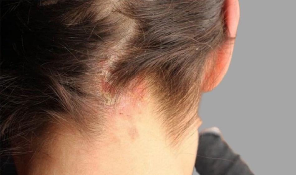 Sử dụng sữa tắm để gội đầu làm tăng nguy cơ gây ra các bệnh về da đầu