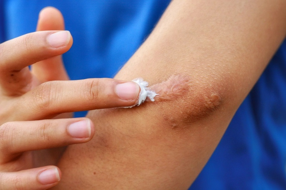 Sử dụng thuốc trị sẹo để ngăn ngừa hình thành sẹo