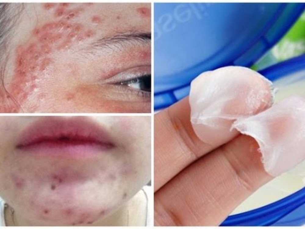 Sử dụng Vaseline để dưỡng da mặt có thể gây mụn và tổn thương da