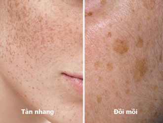 Sự khác biệt giữa tàn nhang và đồi mồi