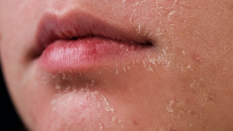 14 Cách Dưỡng Ẩm Cho Da Mặt Bị Khô Để Làn Da Luôn Mềm Mại