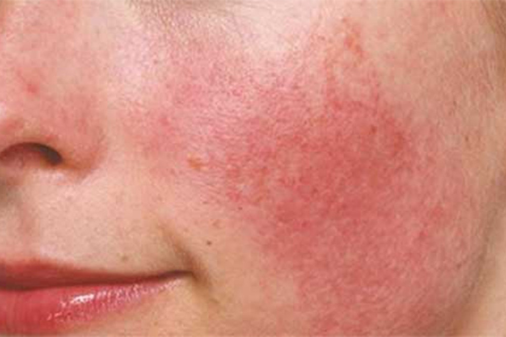 8+ Cách Chăm Sóc Da Bị Kích Ứng Hiệu Quả Nhanh Chóng