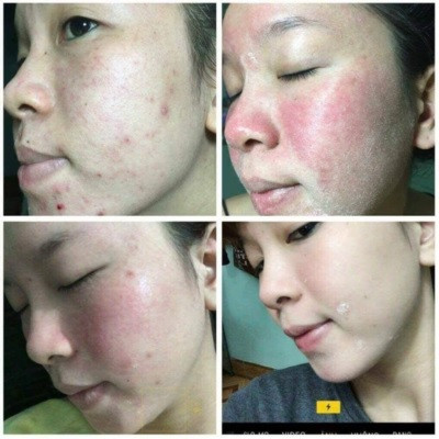 Tác dụng phụ của thuốc rượu