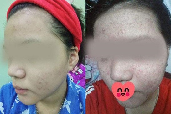 Tác hại của rượu đối với da