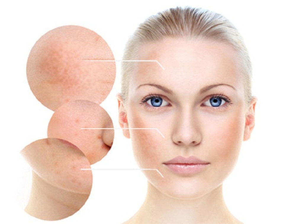 Cách Chăm Sóc Da Sau Khi Trị Nám Bằng Laser Đúng Cách