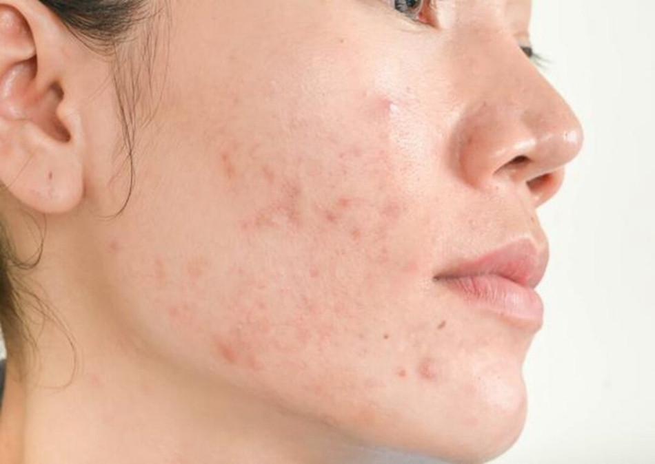Cách Vệ Sinh Da Mặt Mụn Đúng Cách Để Da Khỏe Mạnh