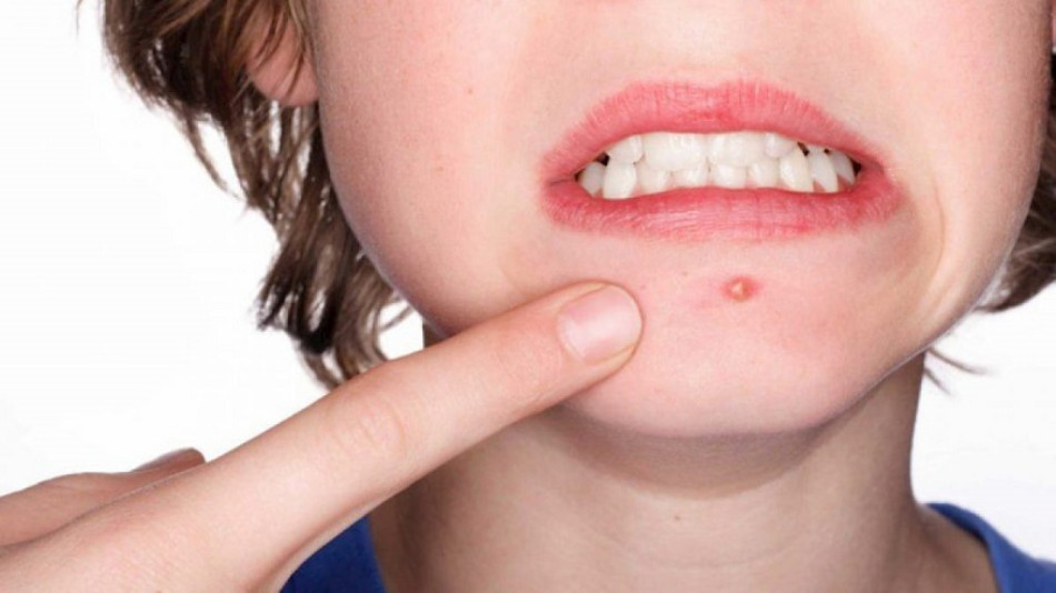 Thay đổi hormone có thể gây mụn