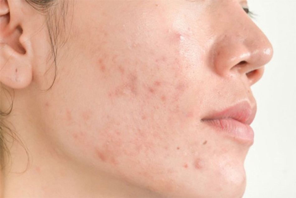 Thay đổi nội tiết tố dẫn đến sự hình thành mụn