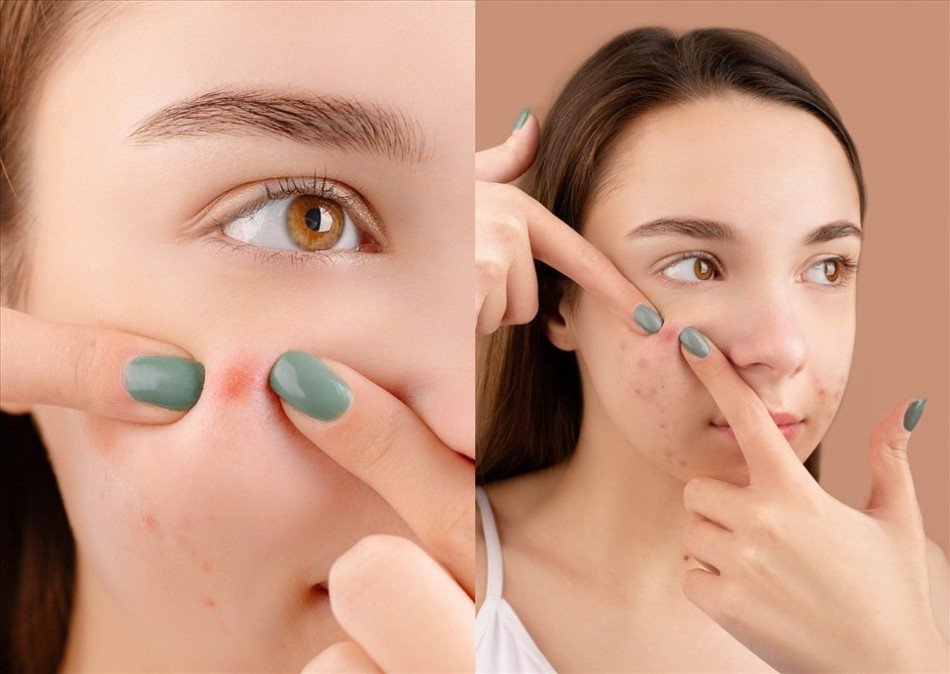 Thói quen nặn mụn khiến da bị lỗ chân lông