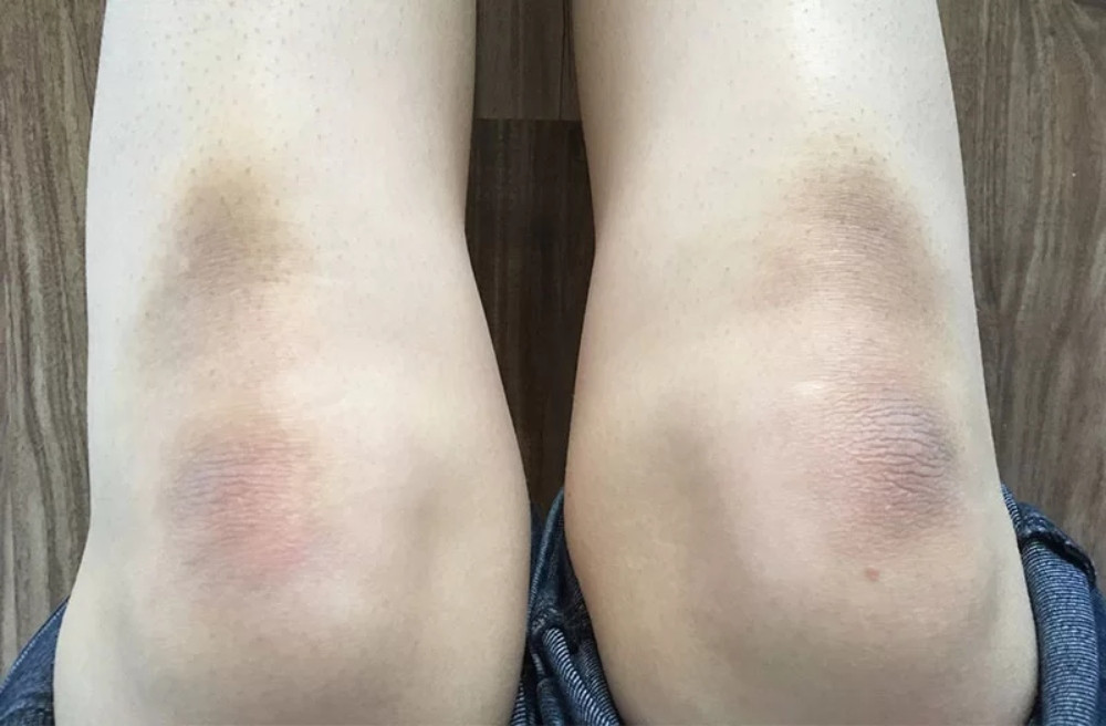 Tích tụ tế bào chết trên đầu gối và khuỷu tay