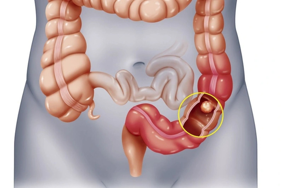 Trà gạo lứt giúp giảm thiểu nguy cơ ung thư ruột kết