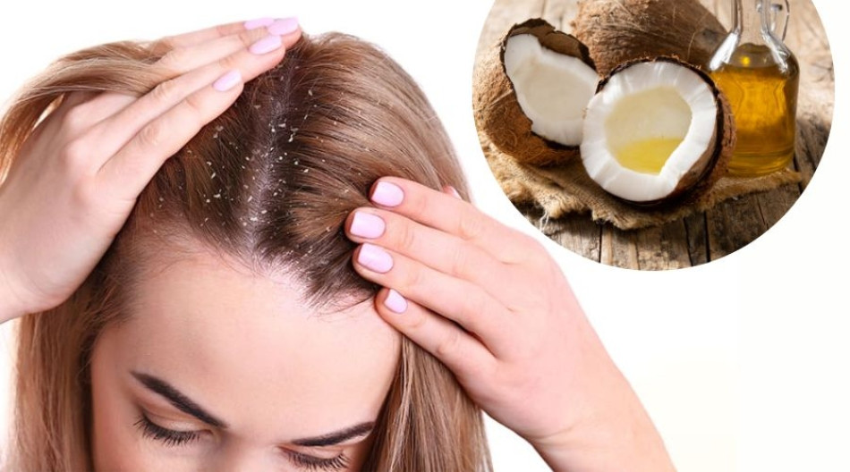 Trị gàu sau khi nhuộm tóc bằng dầu dừa