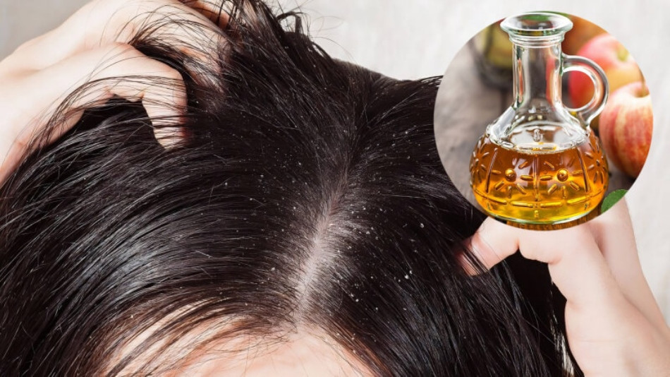 Trị gàu với giấm táo