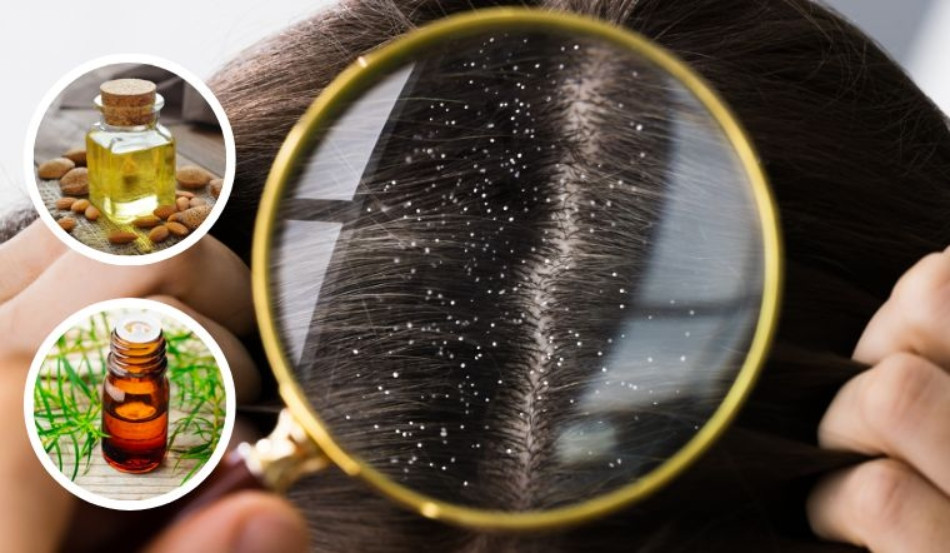 Trị gàu với tinh dầu tràm trà