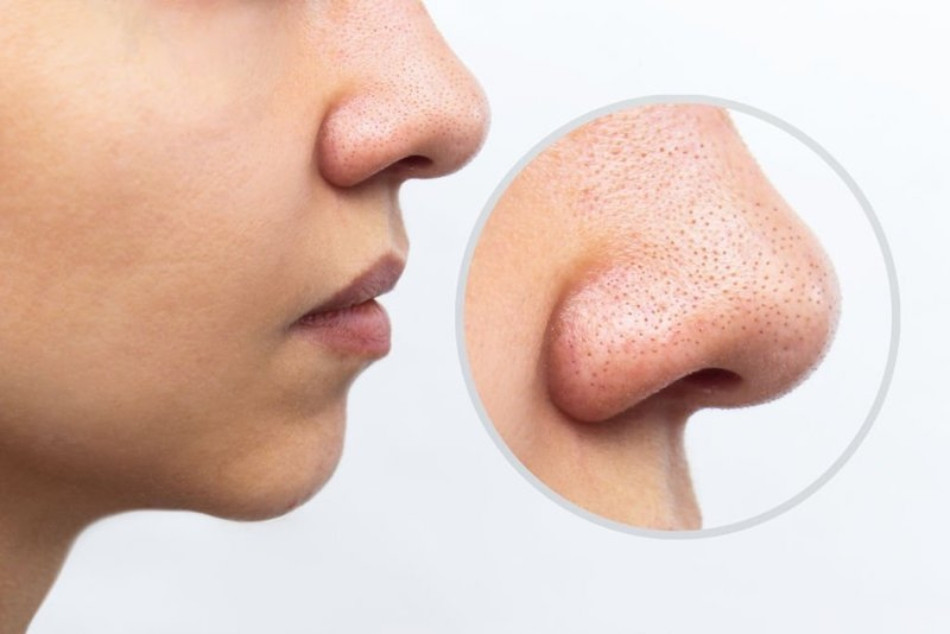 Trị sỏi bã nhờn ở mũi bằng AHA