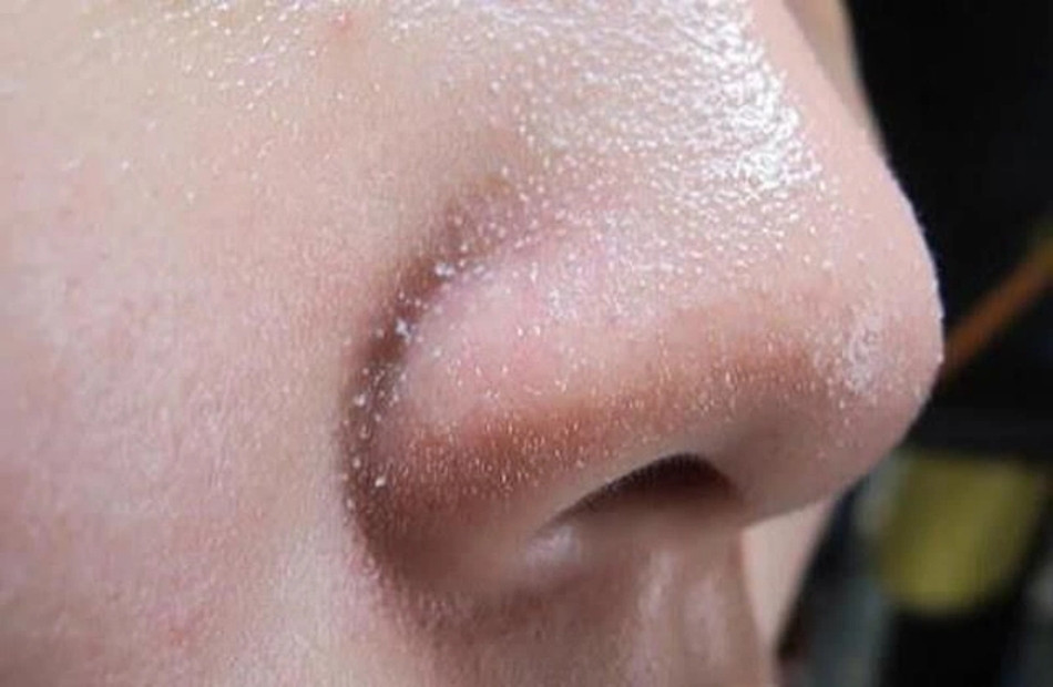 Trị sỏi bã nhờn ở mũi bằng BHA
