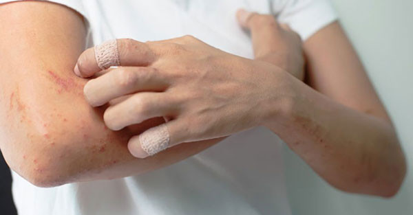 Viêm Da Cơ Địa: Hiểu Rõ Bệnh Và Phương Pháp Điều Trị Hiệu Quả