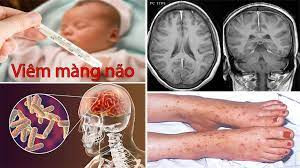 Viêm màng não ở trẻ em là bệnh nguy hiểm