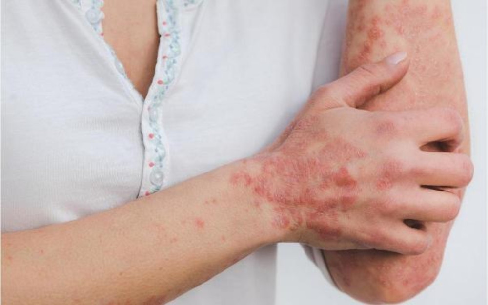 Vitamin E hỗ trợ điều trị bệnh chàm và vảy nến