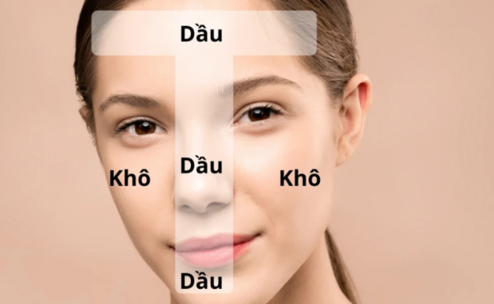 Vùng chữ T là vùng da dễ bị dầu nhờn gây tắc nghẽn lỗ chân lông.